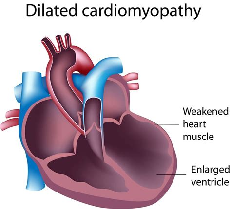 life expectancy with dilated cardiomyopathy